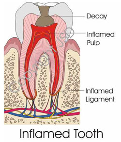 inflammedtooth inflammedtooth
